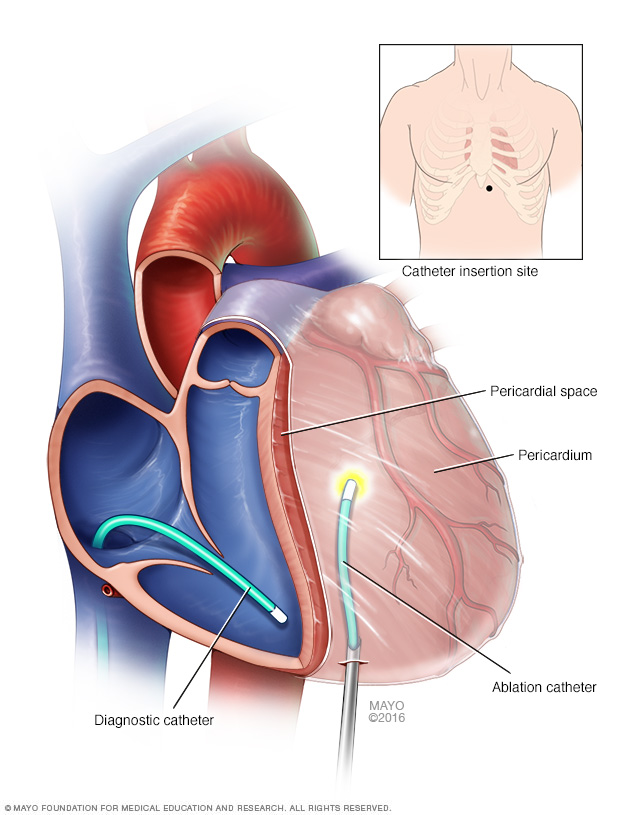 Santana Heart Procedure