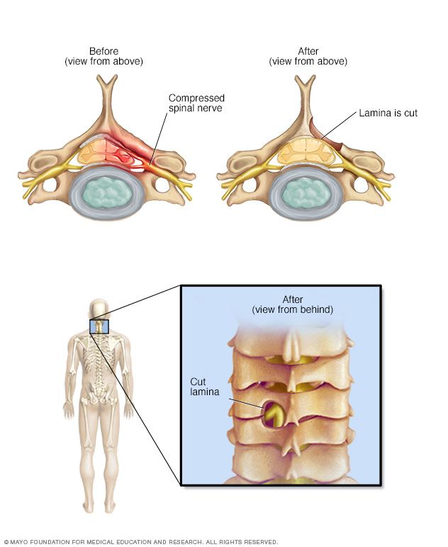 Spinal Stenosis Disease Reference Guide 
