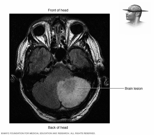 brain-lesions-drugs