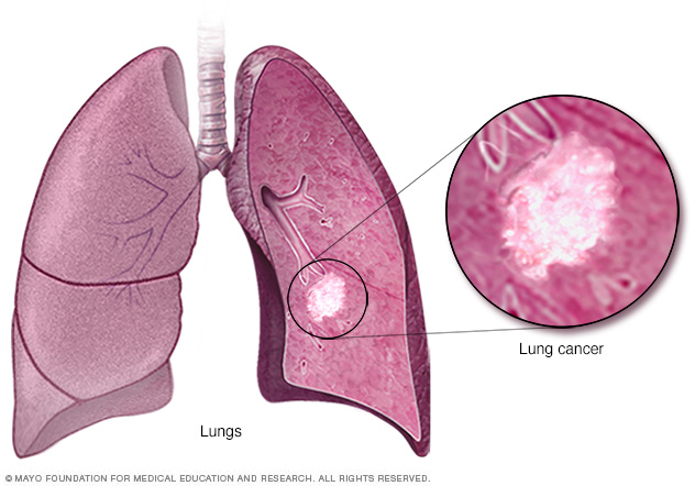 Lungekreft: symptomer, diagnose og behandling