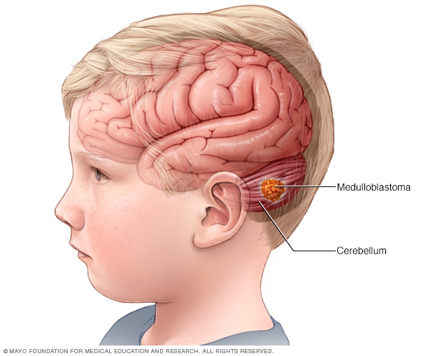 medulloblastoma-disease-reference-guide-drugs