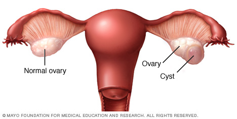 Ovarian cysts Disease Reference Guide - Drugs.com