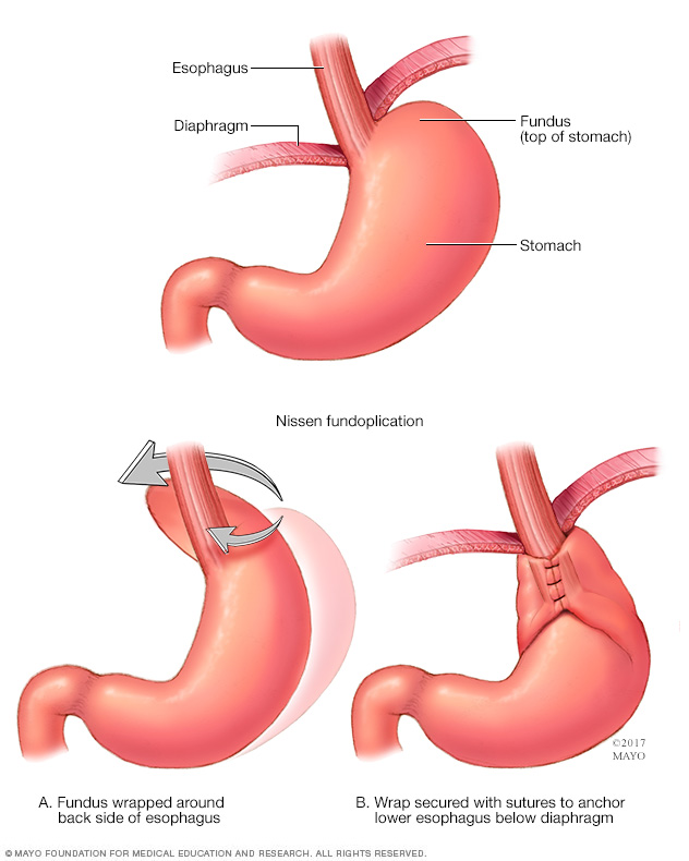 Barrett's esophagus Disease Reference Guide 