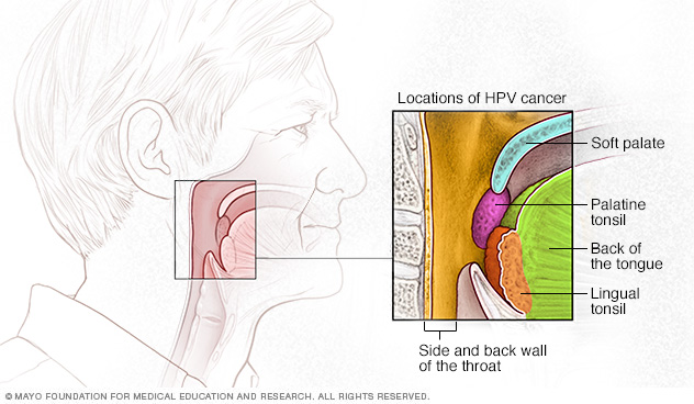 what hpv strain causes throat cancer