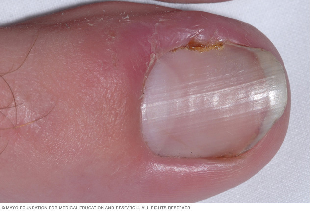 ingrown-toenails-disease-reference-guide-drugs