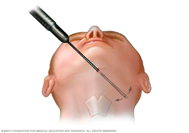 liposuction tumescent procedure cannula common mayo during procedures drugs tube clinic thin mayoclinic open