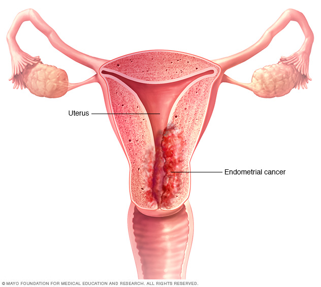 Endometrial Cancer Disease Reference Guide Drugs Com