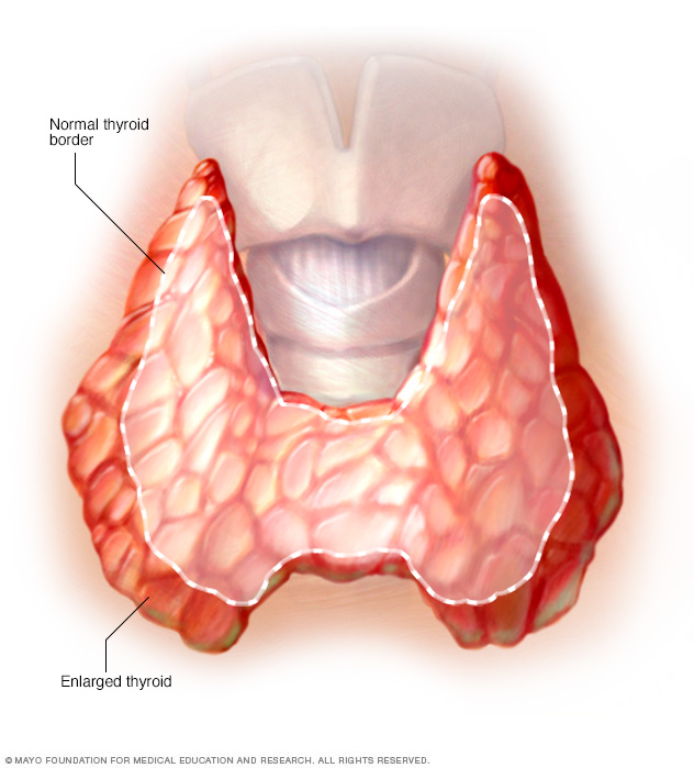 graves-disease-disease-reference-guide-drugs