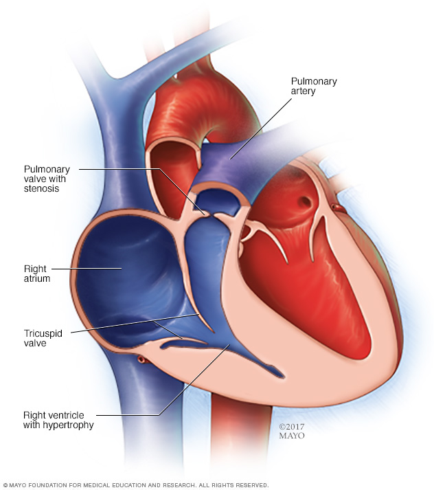 Pulmonary valve stenosis Disease Reference Guide