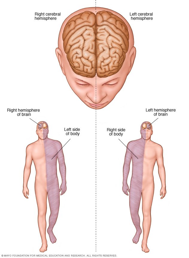 Stroke Disease Reference Guide