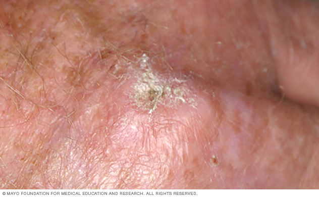 Actinic Keratosis Disease Reference Guide 