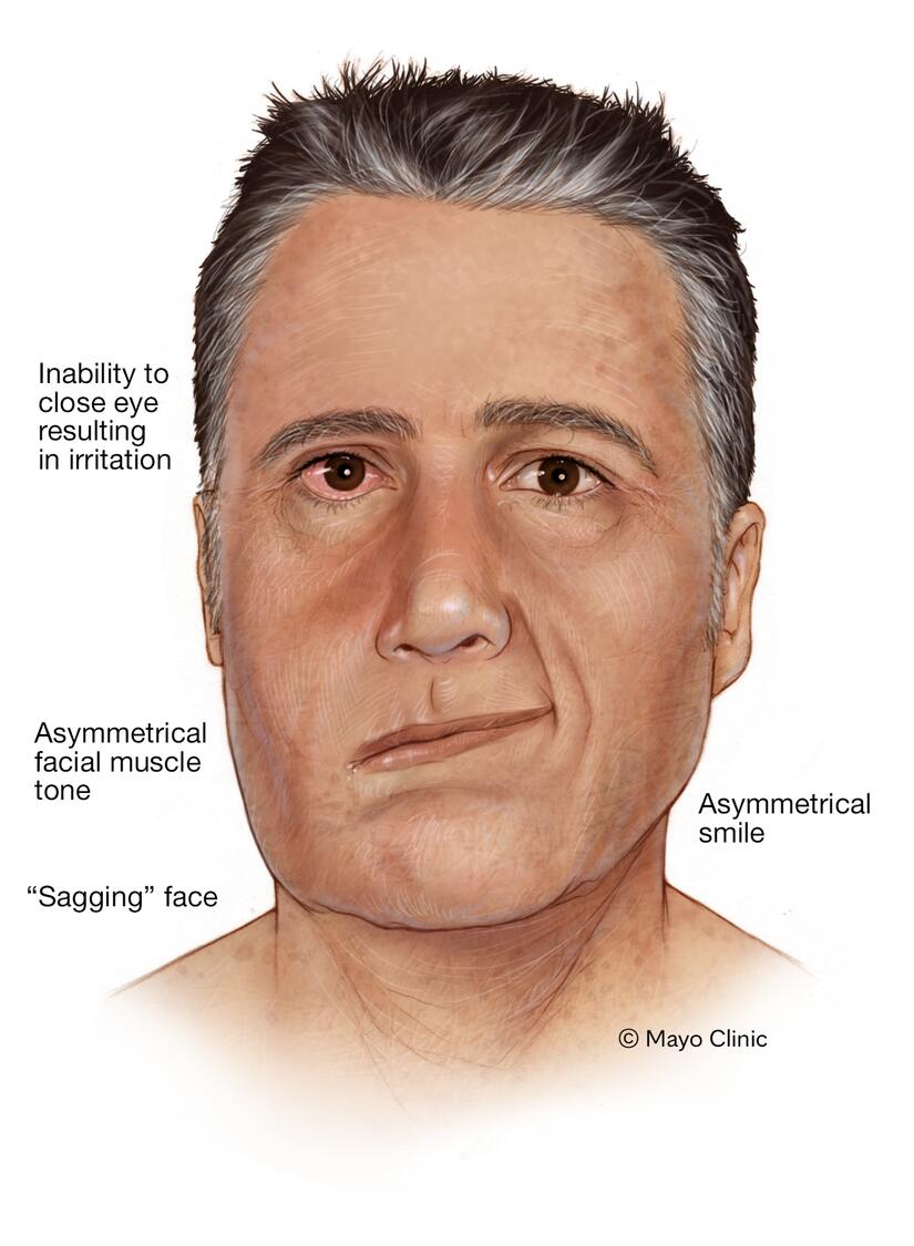 Ramsay Hunt Syndrome Disease Reference Guide Drugs Com