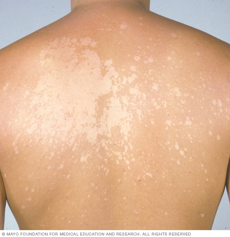 Everything You Need to Know About Tinea Versicolor & Tinea Versicolor  Treatments