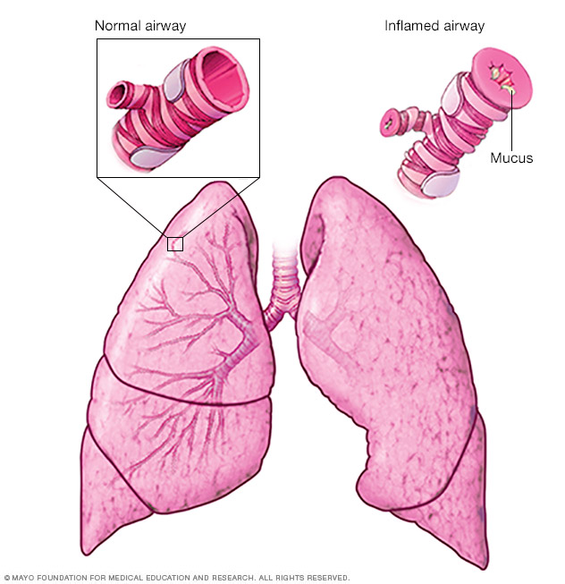 Asthma Disease Reference Guide