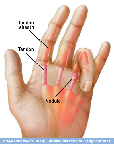 Trigger Finger Disease Reference Guide 6517