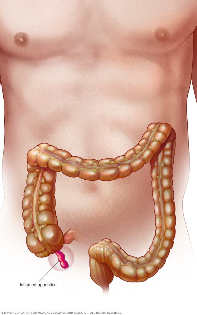 appendicitis-disease-reference-guide-drugs