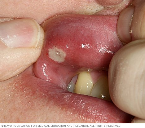 Cankers In Throat 83