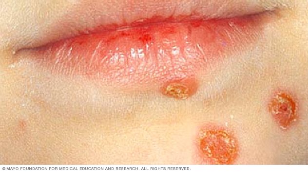 Cold Sores - Type of Facial Lesion on Your Skin