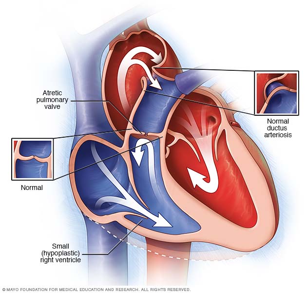 Pulmonary atresia Disease Reference Guide - Drugs.com