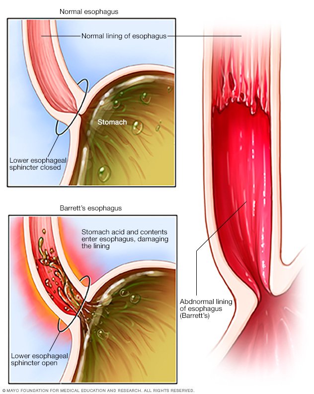 Barrett S Esophagus Disease Reference Guide Drugs Com