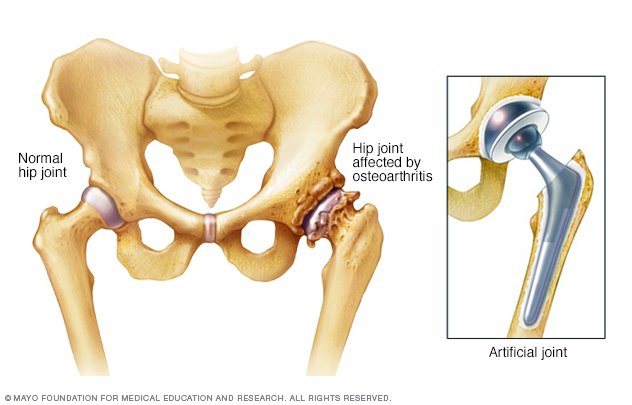 Weight Loss And Osteoarthritis Of The Hip