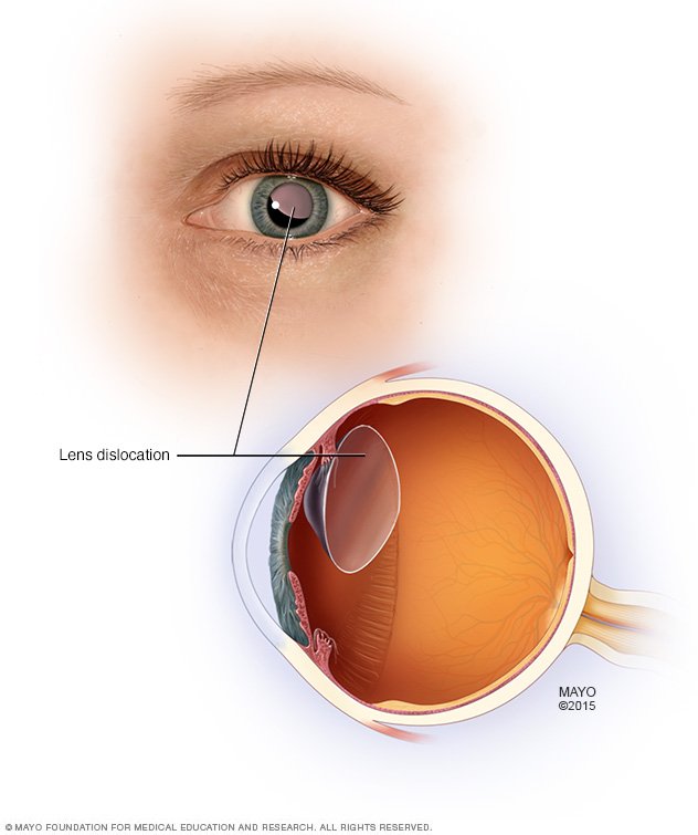 syndrome may experience the dislocation of the lens in their eye