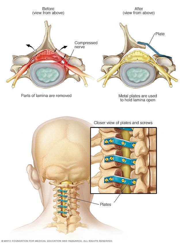 Classification Mechanism And Surgical Treatments For Spinal Canal My XXX Hot Girl