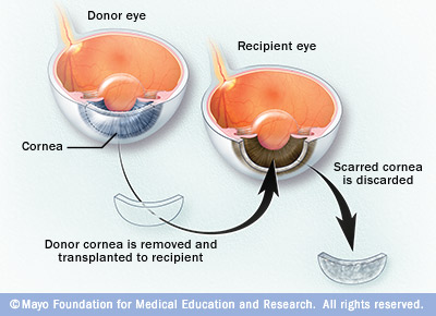 Cornea transplant - Drugs.com