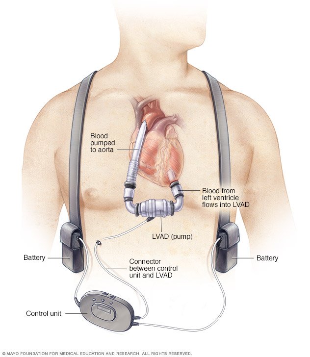 do how use strip test pregnancy u Ventricular (VAD) assist Drugs.com  device