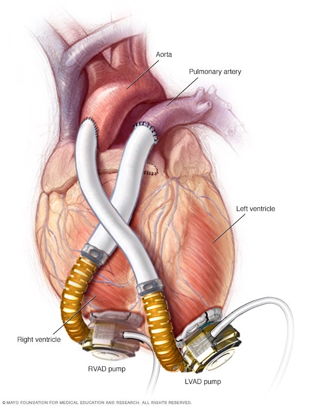 ventricular-assist-device-vad-drugs