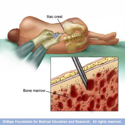 Bone marrow biopsy and aspiration - Drugs.com