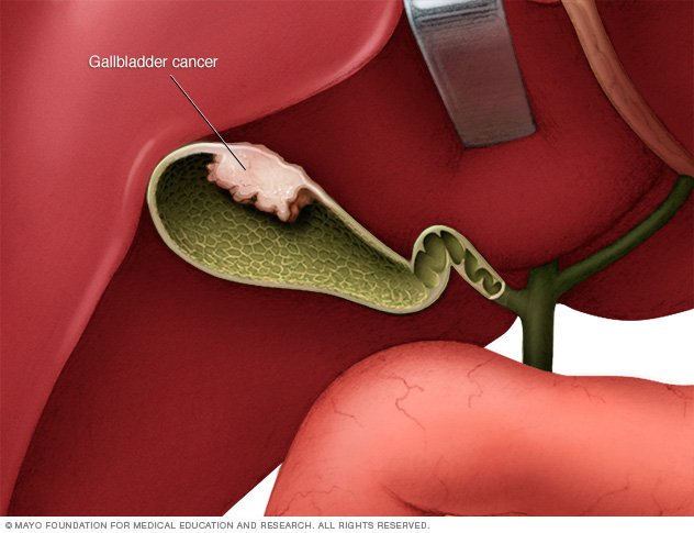 Gallbladder cancer Disease Reference Guide - Drugs.com