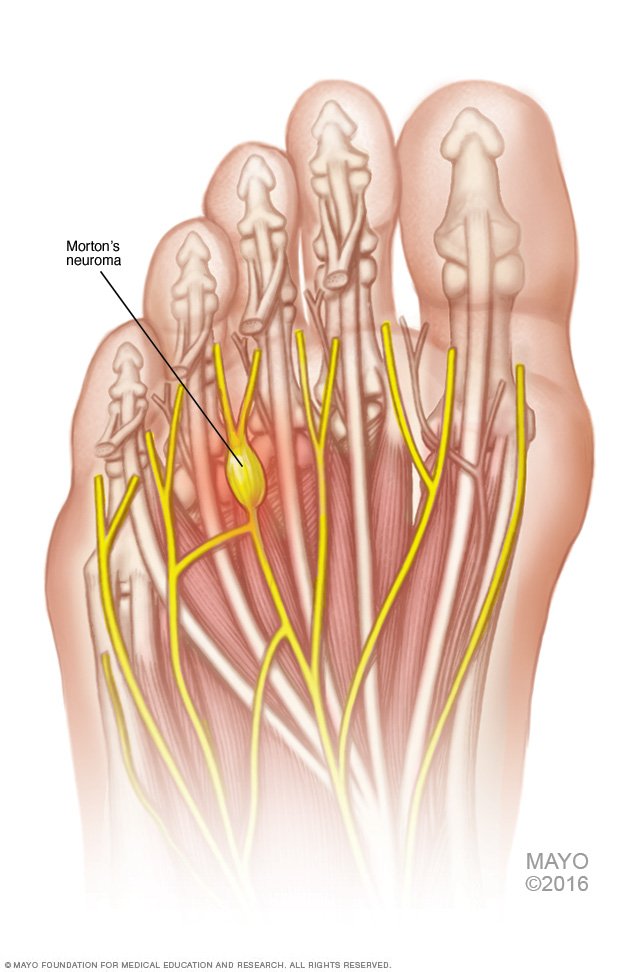 Morton's neuroma Disease Reference Guide