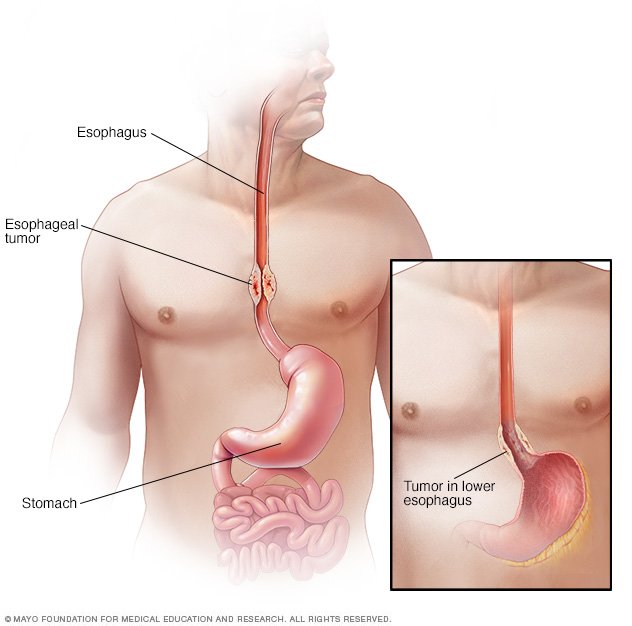 esophageal-cancer-disease-reference-guide-drugs