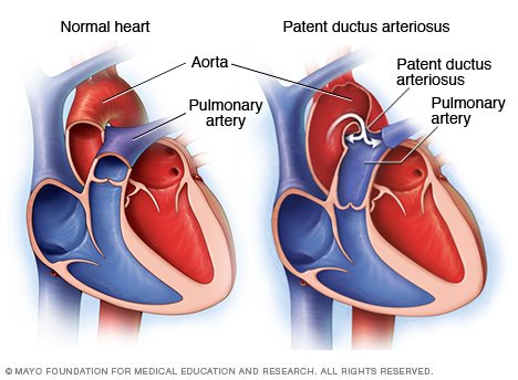 Patent ductus arteriosus (PDA) Disease Reference Guide - Drugs.com