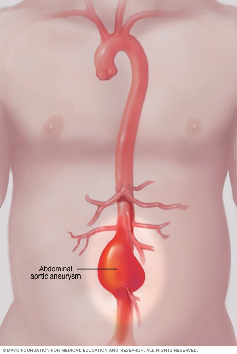 Abdominal aortic aneurysm Disease Reference Guide  Drugs.com