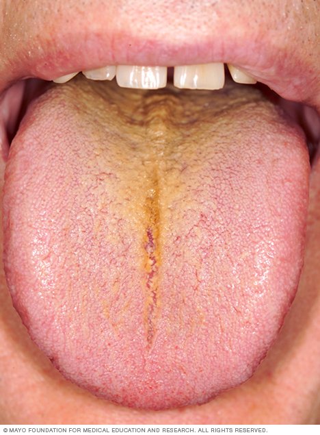 xanax and white tongue