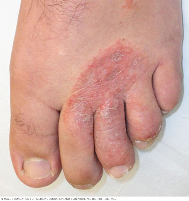 athlete-s-foot-disease-reference-guide-drugs