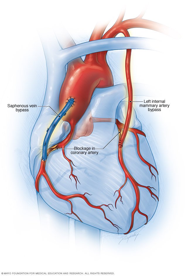 Coronary Artery Disease Disease Reference Guide - Drugs.com