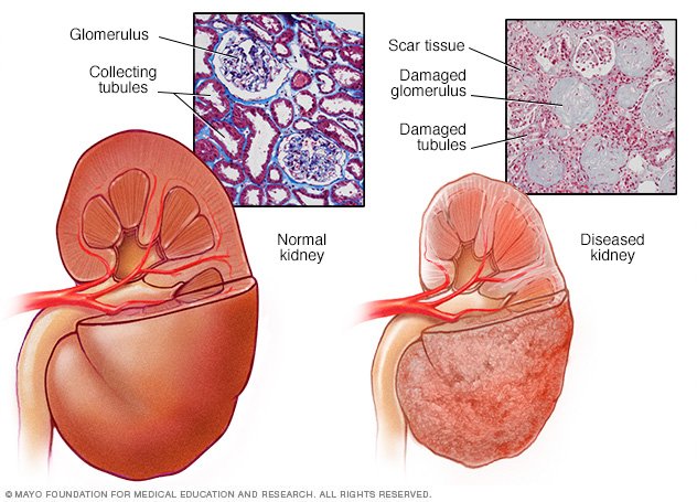 how bad is lasix on kidneys