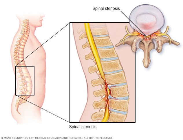 Can Lumbar Spinal Stenosis Cause Leg Weakness