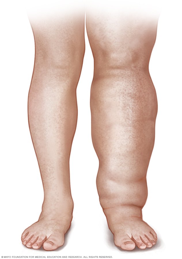 Lymphedema Disease Reference Guide 