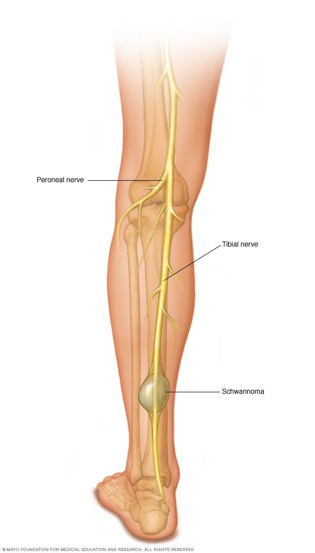 peripheral-nerve-tumors-disease-reference-guide-drugs