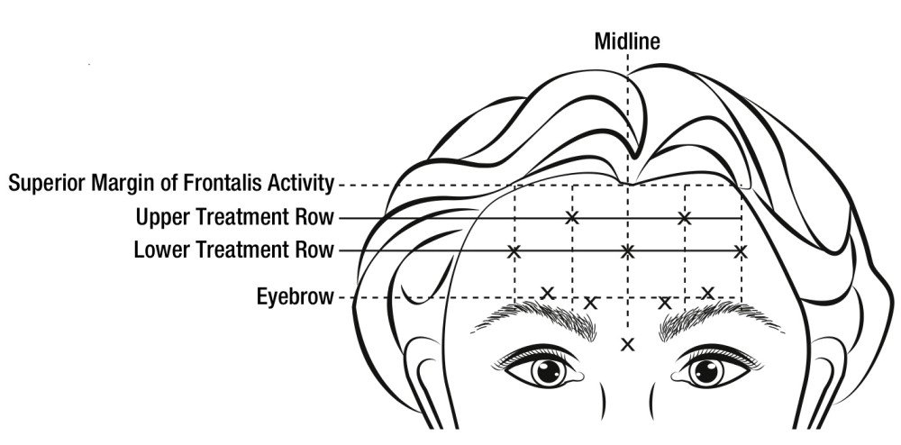 botox-cosmetic-dosage-guide-drugs