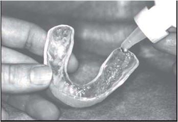 fluoride brush trays dental custom voice